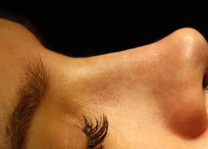 ринопластика пластическая операция rhinoplasty yerevan armenia